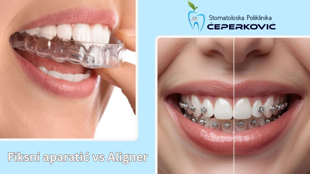Fiksni-aparatic-vs-aligner-1200x675.jpg