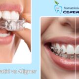 Fiksni aparatić vs aligner